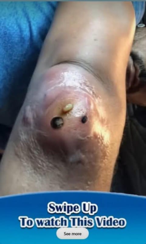 ST, Removal of a fairly large epidermal cyst on the elbow.