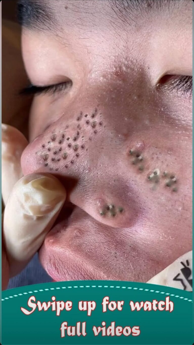 Tips For Squeezing Blackheads On Nose.