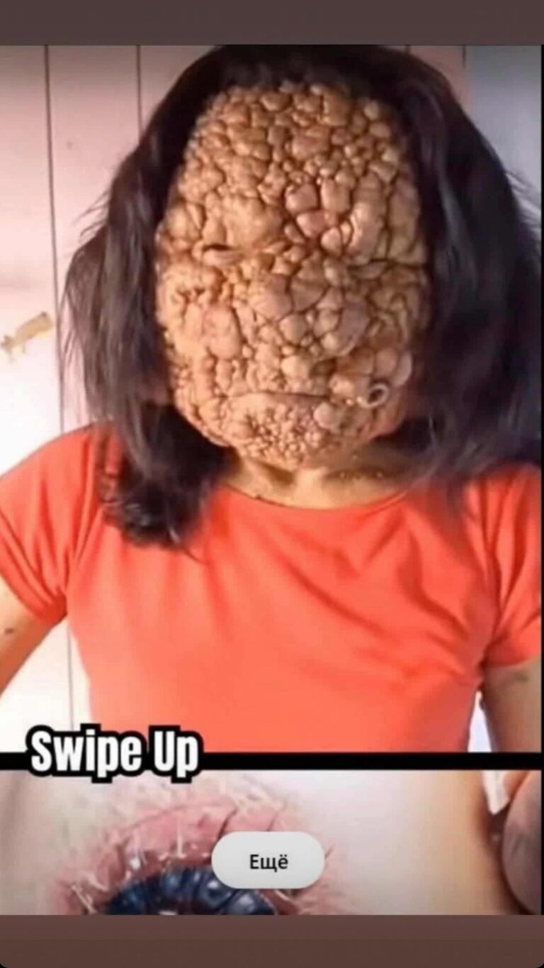 Acne occurs when hair follicles become clogged.