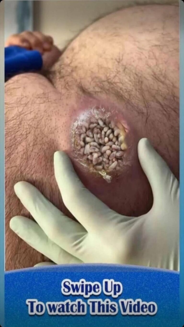 Their acne is severe.