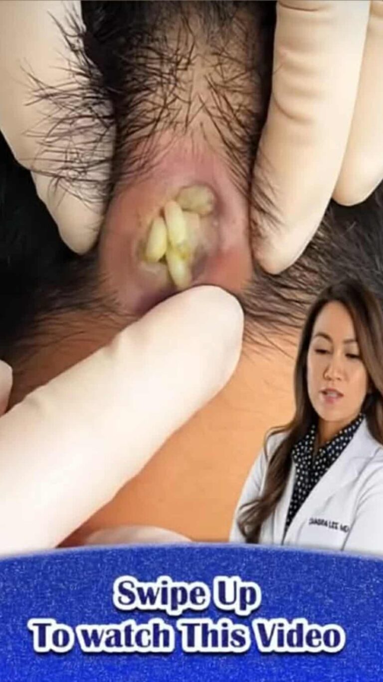 Their acne is severe