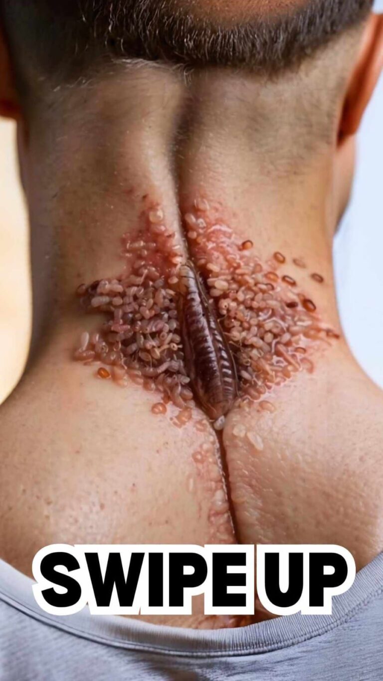 Acne occurs when hair follicles become clogged.