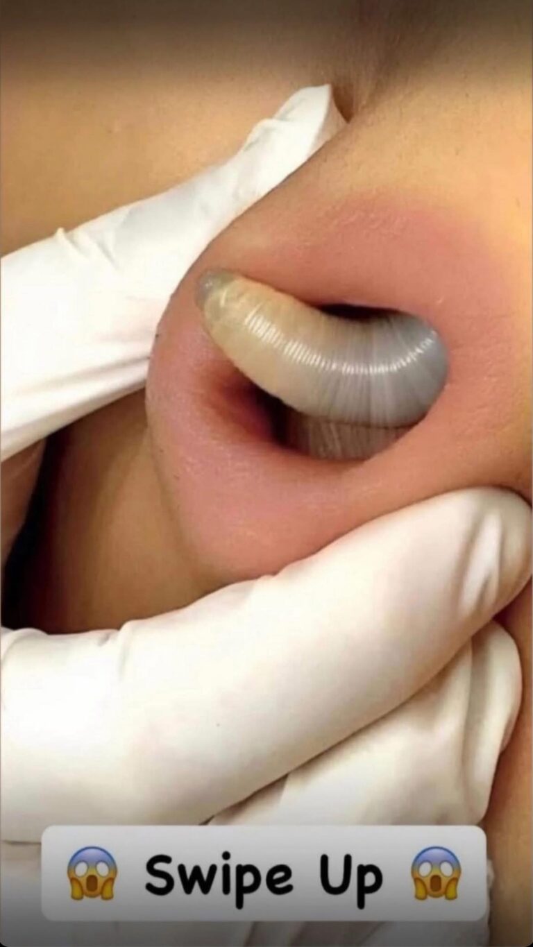 Why You Keep Getting Pimples Inside Your.