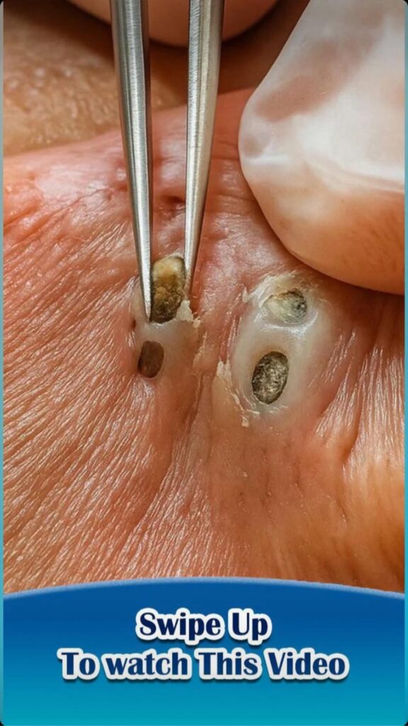 6 Types of Acne and What Might Cause Them.