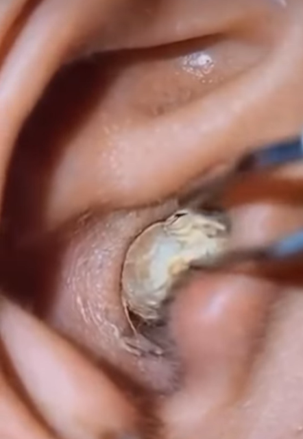 Causes, Treatment, Home Remedies & More.