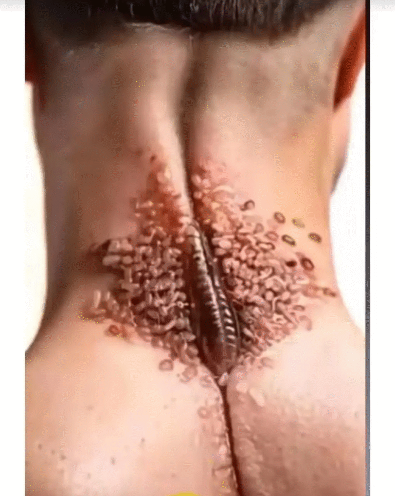 Skin Infestations in Humans: Understanding and Treating Parasitic Infestation